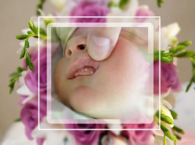 ​宝宝新生第一年的十种常见病之 鹅口疮