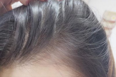 ​真实记录停米诺地尔的三个月，以及如何以正确的方式“收尾”