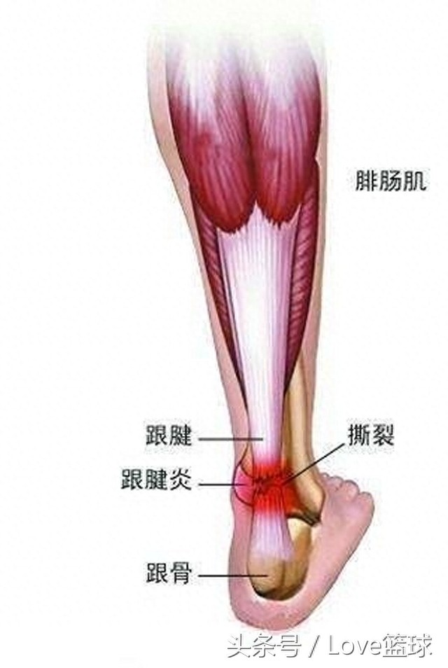 三张图告诉你,跟腱断裂有多恐怖!