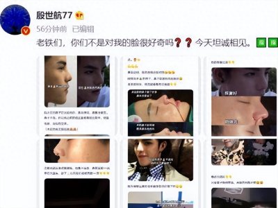 殷世航公开了整容经历,鼻子被缝很多针安慰自己再忍一会