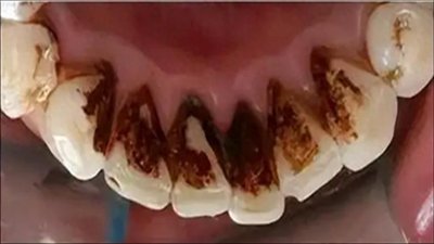 烟渍又黑又臭难去除?1招就能让牙齿亮洁如新!在家就能做!